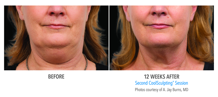 Coolsculpting Before and After Double Chin