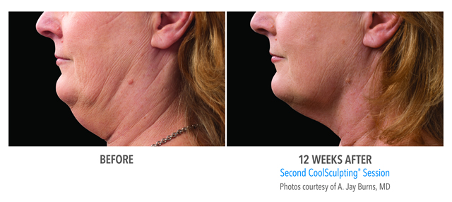 CoolSculpting for the Chin Before and After