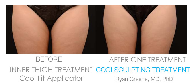 Coolsculpting Inner Thigh before and after