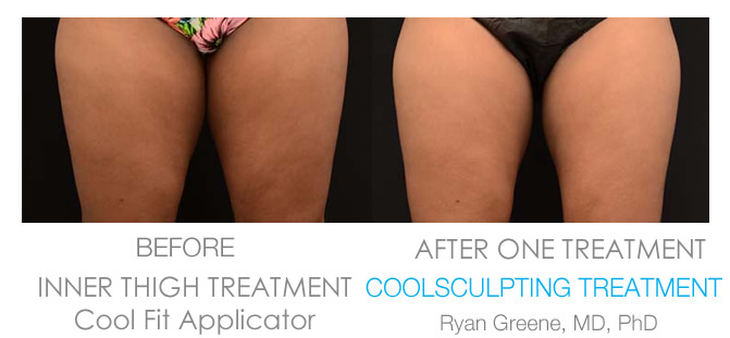 Coolsculpting Weston Inner Thigh before and after