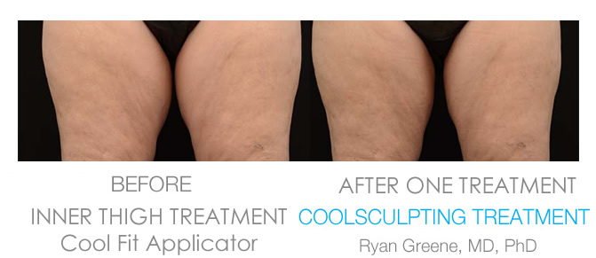 Ft Lauderdale Coolsculpting Inner Thigh before and after