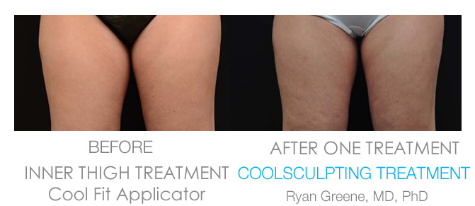 Coolsculpting Inner Thigh before and after Weston