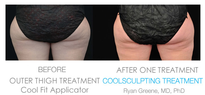 Coolsculpting Outer Thigh before and after Weston